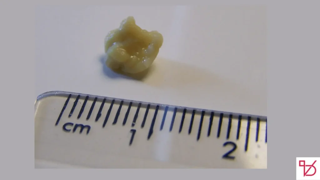 Popping Hidden Tonsil Stones
