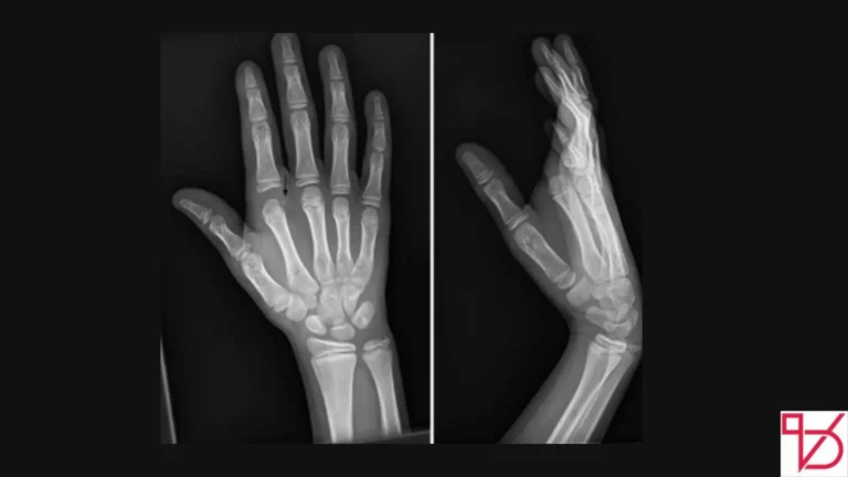 Dislocated Thumb