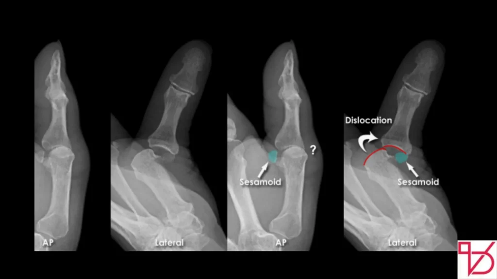 Dislocated Thumb