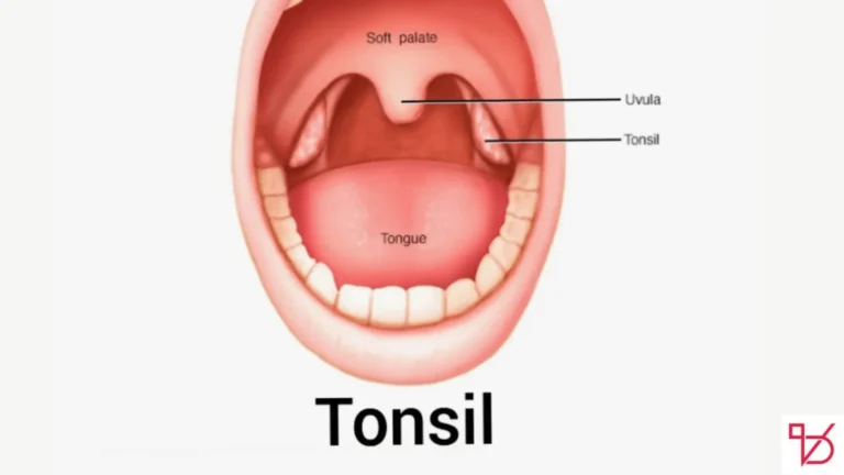 Popping Hidden Tonsil Stones