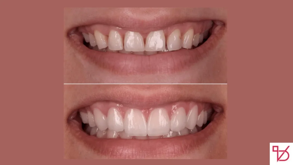 Teeth Prepped for Veneers