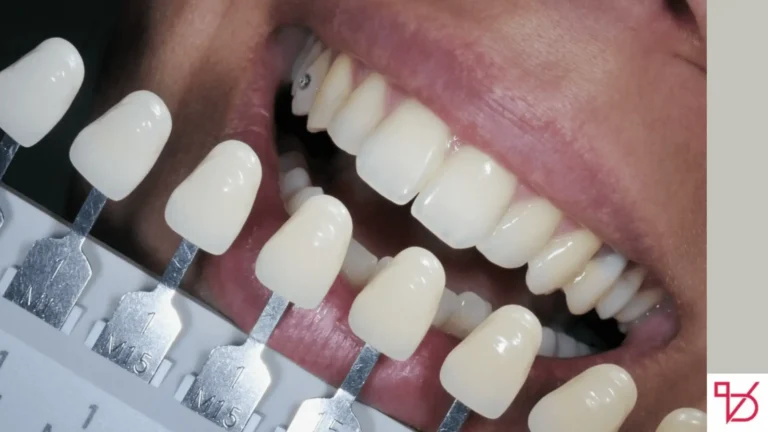 Teeth Prepped for Veneers