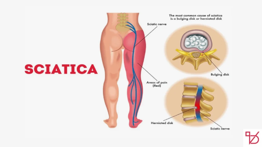 Say Goodbye to Sciatic Nerve Pain in Just 10 Minutes with This Natural Method